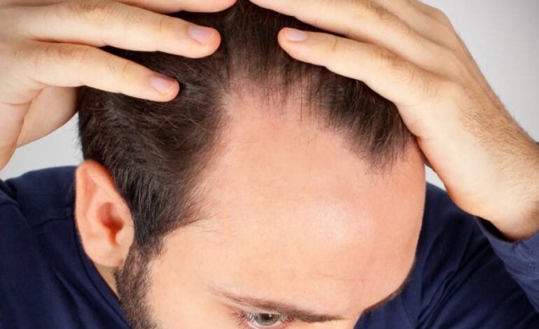 Causes of Hair Loss in Men